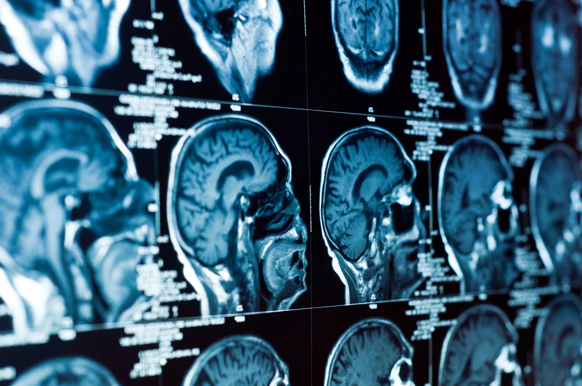 TBI Lawyer Colorado Springs, CO